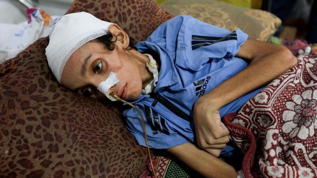 영양실조로 가자시티의 알-시파 병원에 입원한 모사브 알-데브스(14)