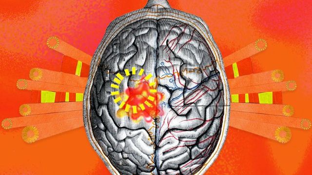 붉은색으로 이상 부위가 표시된 두뇌