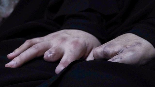 한 손은 두 손가락이 거의 완전히 없어진 상태이고, 다른 손은 손가락이 거의 남아 있지 않은 상태다