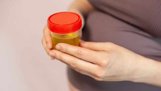 소변샘플을 들고 있는 여성의 모습