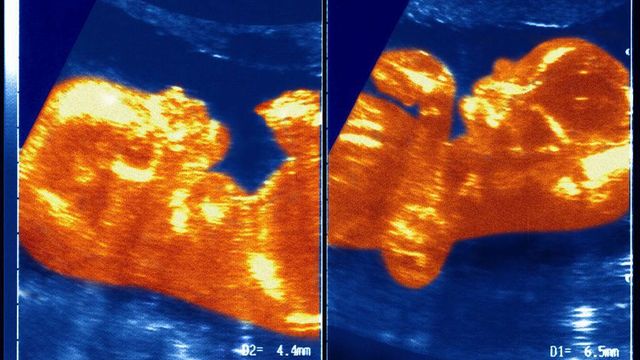 쌍둥이의 초음파 사진