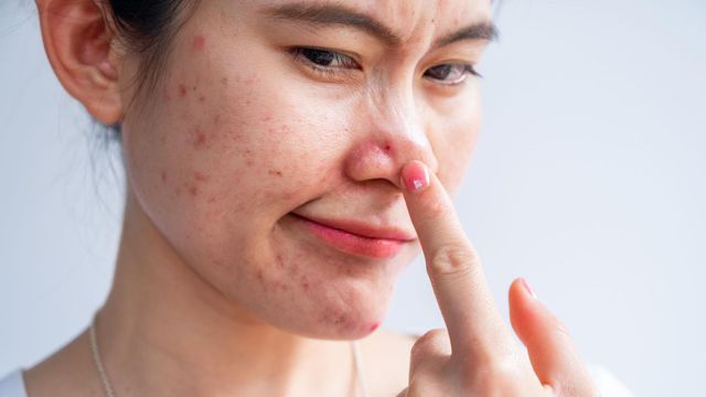 여드름이 난 여성의 얼굴