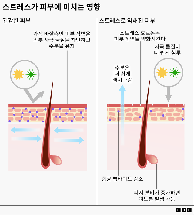 건강한 피부와 스트레스로 손상된 피부의 차이