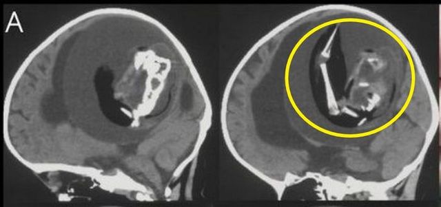 두개골에서 발견된 기생 태아ⓒ트위터 갈무리