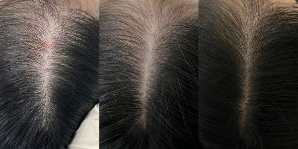 피부케어와 마찬가지로 두피도 근본케어로 접근해야 한다는 사실을 깨닫고, 두피케어 영역의 심도 있는 연구를 진행한 서미지 대표는 피부 미용과 의료적 지식을 결합해 독창적인 피부 및 탈모 관리 프로그램을 개발했다. 사진은 모리바이브 헤어 케어 프로그램의 실제 임상 사진.ⓒ 모리바이브