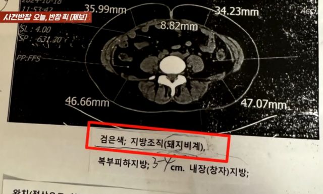 환자의 검사 결과지에 '돼지비계'라고 적은 의사의 태도가 공분을 사고 있다. /사진=JTBC '사건반장' 캡처