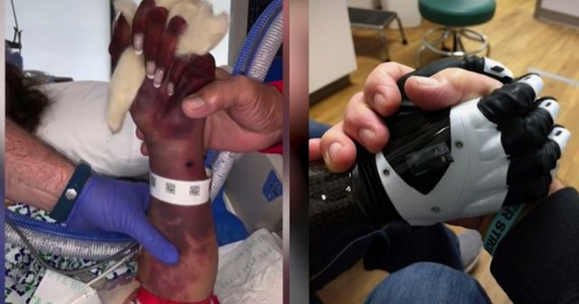 희귀 박테리아에 감염된 마리 트레이너가 사지를 절단했다. 사진은 미국 오하이오주에 거주 중인 마리 트레이너의 수술 전 팔의 모습(왼쪽)과 현재의 모습. /사진=폭스8 캡처(마리 트레이너 제공)