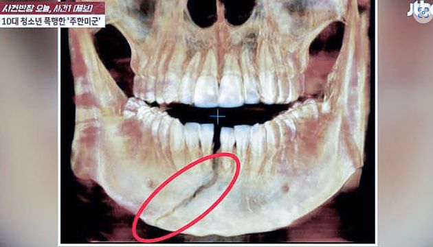 주한미군에게 폭행당해 턱뼈가 골절된 10대 남학생이 평생 후유장애가 남을 수 있는 중상을 입은것으로 알려졌다. /사진=JTBC사건반장 캡쳐