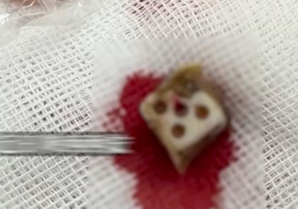 코에 주사위가 들어있는 걸 모른채 살아온 남성의 사연이 화제다. /사진=사우스차이나모닝포스트(SCMP) 캡처