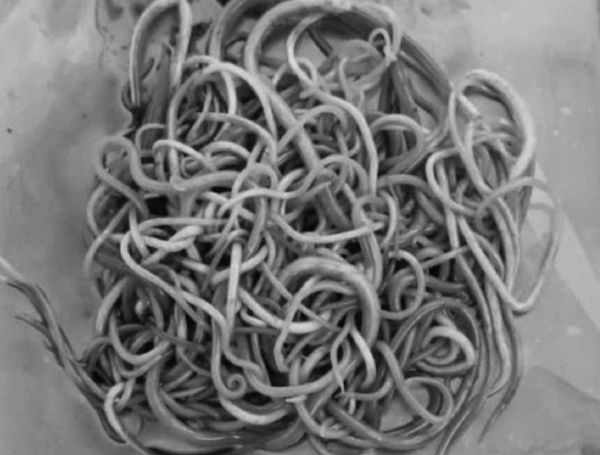 베트남에 사는 2세 남아의 소장에서 100여마리의 회충이 발견됐다. 사진은 해당 아이 소장에 있던 회충의 모습. /사진=뚜오이째 홈페이지 캡처