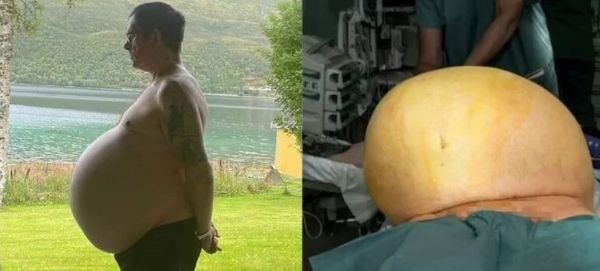 노르웨이의 한 남성이 비만이라고 믿어왔던 뱃살이 거대 악성 종양이었단 소식이 전해졌다. 사진은 사연의 주인공인 토마스 크라우트의 모습. /사진=데일리메일 캡처