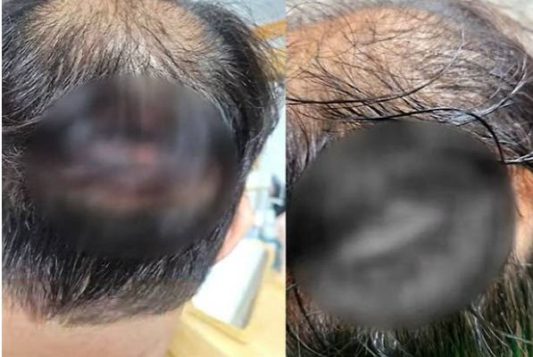 모발이식 수술을 받은 50대 남성이 두피가 괴사하는 일이 벌어졌다. /사진=JTBC '사건반장' 캡쳐