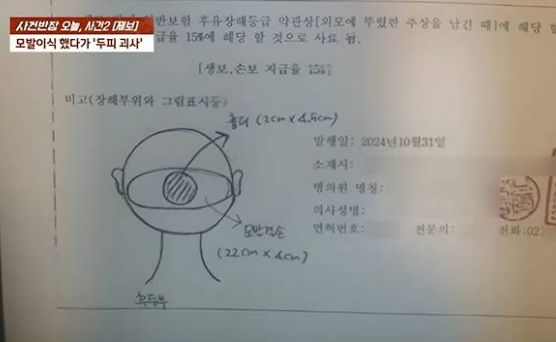 모발이식 수술을 받은 50대 남성이 두피가 괴사하는 일이 벌어졌다. /사진=JTBC '사건반장' 캡쳐