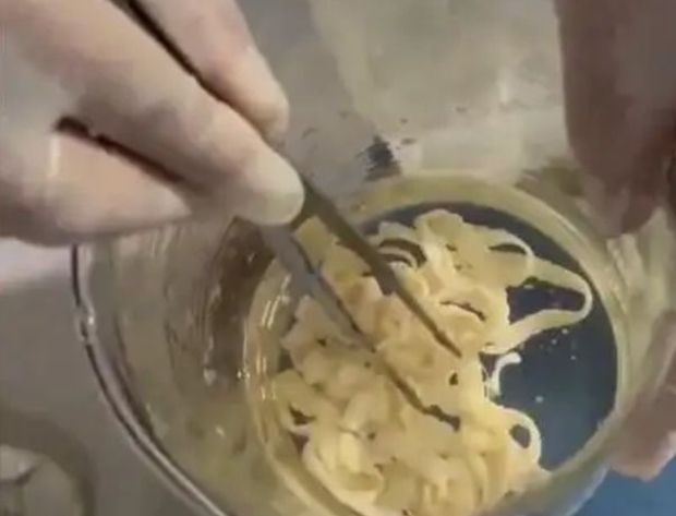 한 여성이 몸속에서 10m길이의 살아있는 기생충이 발견돼 충격을 주고 있다. /사진=BAIDU 캡쳐