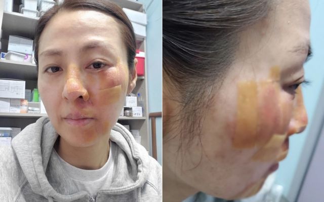 배우 전혜진이 넘어져 얼굴을 다치는 사고를 입었다./사진=전혜진 인스타그램