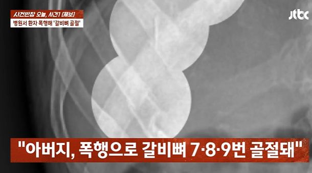 전남 목포 한 병원에서 보호사에게 폭행당해 갈비뼈가 골절됐다는 사연이 전해졌다. /사진=JTBC '사건반장' 캡처