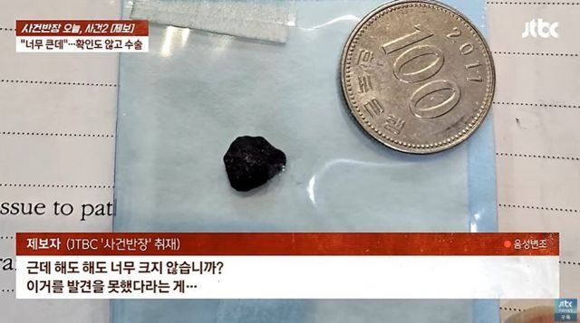 남성이 병원에서 봉합수술을 받았는데 의사가 박힌 돌을 빼지 않고 그대로 꿰매 논란이다. 사진은 해당 이물질의 크기를 비교한 사진. /사진=JTBC '사건반장'
