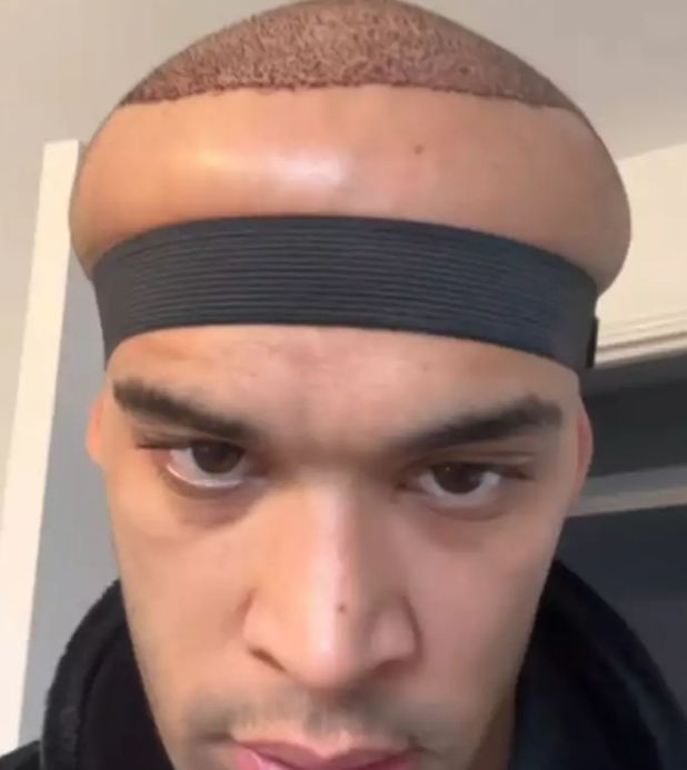 영국 한 남성이 모발 이식 부작용으로 머리가 풍선처럼 부푼 부작용 증상을 공유했다. 사진은 모발 이식 후 머리 부기 증상이 나타난 영국 댄서 카나 플렉스의 모습. /사진=래드바이블 캡처 