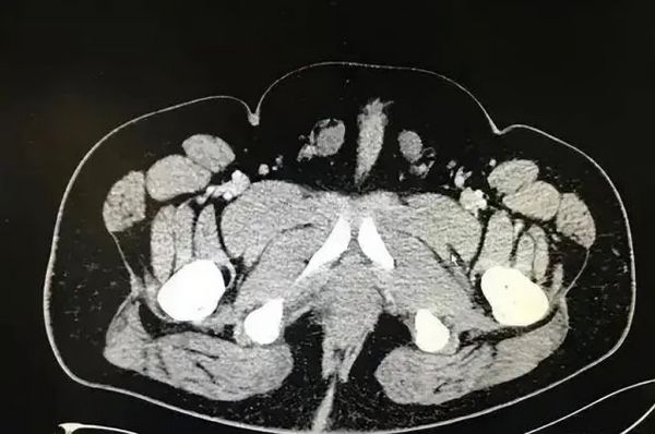 사진은 남녀 생식기를 모두 가진 류씨의 엑스레이. /사진=웨이보 캡처