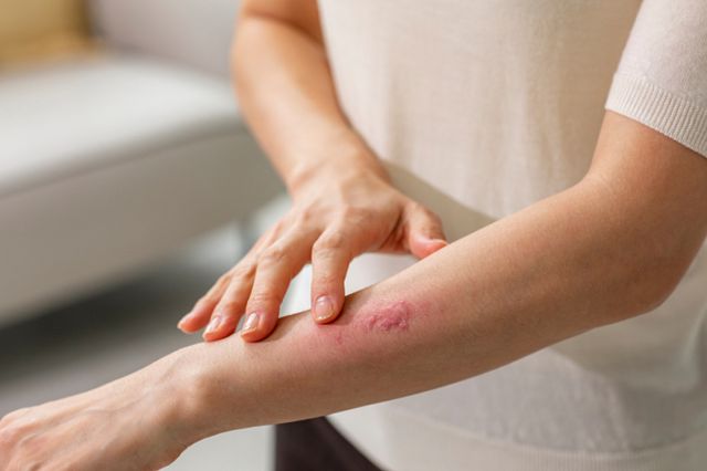 대상포진 발병 원인과 증상이 주목된다. 사진은 기사 내용과는 무관함. /사진=이미지투데이