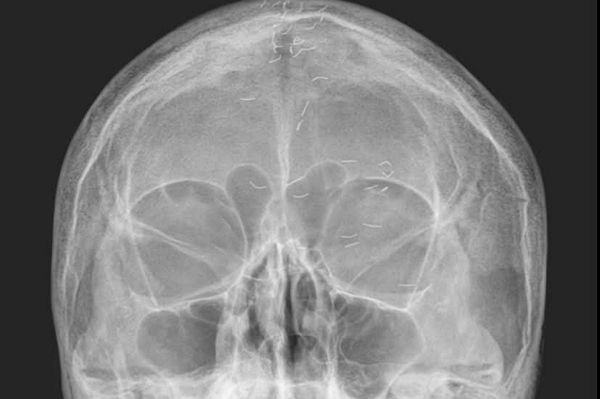 60대 여성 환자의 머릿속에 수많은 이물질이 흩어져 있는 모습이 담긴 엑스레이 사진이 주목받는 가운데 전문가가 '금침 요법의 흔적'이라고 설명했다. 사진은 양성관 의정부백병원 가정의학과 과장이 SNS에 공개한 60대 여성 환자의 머리 엑스레이. /사진=양성관 의정부백병원 가정의학과 과장 페이스북 캡처
