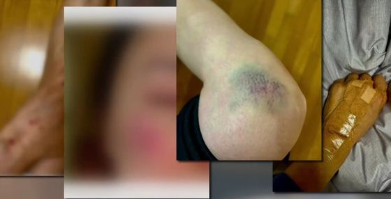 길을 가던 여성이 레스토랑 통유리창에 깔려 전치 4주의 상해를 입었지만, 레스토랑 측이 합의금을 주지 않아 고소를 진행 중인 것으로 전해졌다. /사진=TV조선 방송캡처