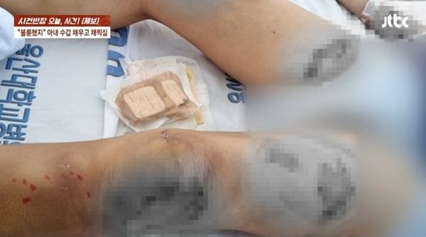 외도를 의심해 아내에게 잔혹 행위를 저지른 남성이 실형을 선고받았다. 사진은 남편에게 폭행당한 아내 A씨의 모습. /사진=JTBC '사건반장' 캡처