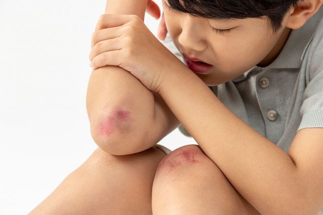 찰과상 치료법이 주목된다. 사진은 기사 내용과는 무관함. /사진=이미지투데이