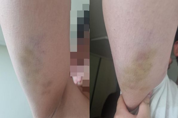 조카가 동급생으로부터 백초크로 목이 졸리는 등 지속적인 학교 폭력을 당해왔다는 주장이 제기됐다. 사진은 동급생에게 1년 넘게 학교 폭력을 당해온 조카의 모습. /사진=온라인커뮤니티 보배드림 캡처