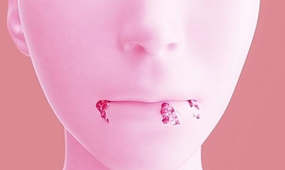 중국의 한 20대 여성이 노래방 마이크에 입을 댄 후 헤르페스에 감염돼 8년 간 앓고 있다는 소식이 전해졌다. 사진은 기사 내용과 무관함. /사진=이미지투데이