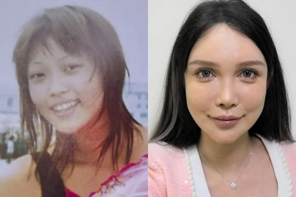 중국 여성이 성형수술을 총 100번 받았다고 밝혔다. 사진은 (왼쪽) 성형수술을 받기 전 14세였던 애비 우의 모습. (오른쪽) 성형수술을 총 100번 받은 애비 우의 모습. /사진=BBC 홈페이지 캡처