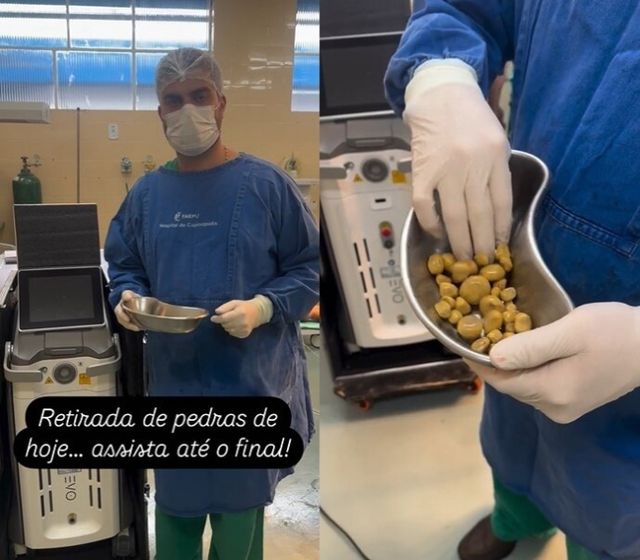 브라질 한 남성이 매일 콜라를 마시다 방광에서 결석 35개가 발견됐다. 사진은 탈레스 프랑코 데 안드라데 박사가 제거한 결석을 보여준 모습. /사진=drthalesandrade 인스타그램 캡처