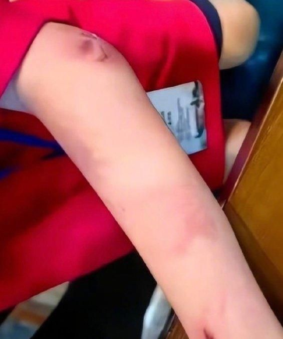 9살 바둑기사 주모신군이 친부에게 오랜 시간 폭행 당한 사실이 밝혀졌다. 사진은 폭행으로 상처 입은 주군의 팔. /사진=시나닷컴 홈페이지 캡처