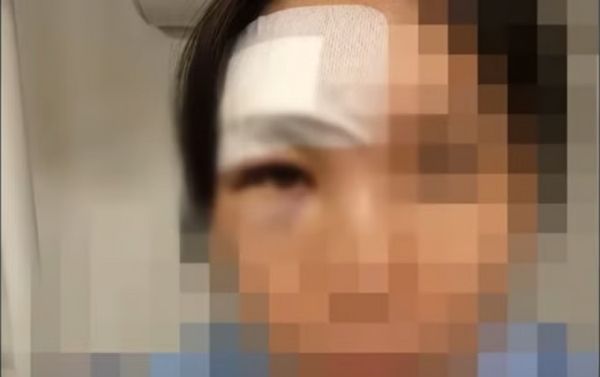 헬스장에서 지나가던 남성이 건드려 떨어진 20㎏ 바벨에 맞아 뇌진탕에 걸린 사연이 전해졌다. 사진은 헬스장에서 지나가던 남성이 건드린 바벨이 얼굴로 떨어져 부상을 입은 여성 모습. /사진=JTBC '사건반장' 캡처