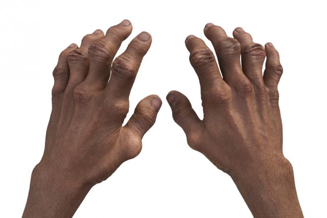 류마티스관절염의 증상과 치료법이 주목된다. 사진은 기사 내용과 무관함. /사진=클립아트코리아 