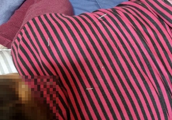 한의사 행세를 하며 수년에 걸쳐 불법 의료 행위를 한 70대가 구속 상태로 검찰에 넘겨졌다. 사진은 암환자 120여명을 상대로 불법 침 시술을 한 70대 한의사가 실제로 불법 의료행위를 한 모습. /사진=뉴시스