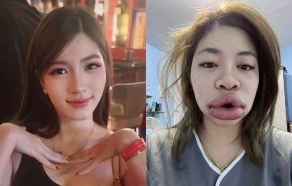 태국 여성 키티야 메나루지가 입술 필러 시술 후 심각한 부작용을 호소했다. 사진은 태국 여성 키티야 메나루지의 원래 모습과(왼쪽) 입술 필러 부작용으로 얼굴이 부어오른 모습. /사진=페이스북 캡처
