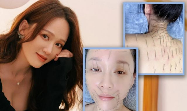 타이완에서 배우로 활동 중인 조 첸 차오엔(46)이 자신의 피부 미용 비결은 침을 맞는 것이라고 밝혔다. 사진은 침을 맞은 조의 모습. /사진=사우스차이나모닝포스트 홈페이지 캡처