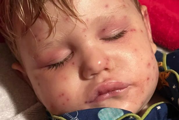 미국 조지아주에서 2살 남자아이가 말벌에 150곳 이상 쏘여 생명 위독 상태다. 사진은 말벌에 쏘인 베컴 리드의 모습. /사진=뉴욕포스트 홈페이지 캡처