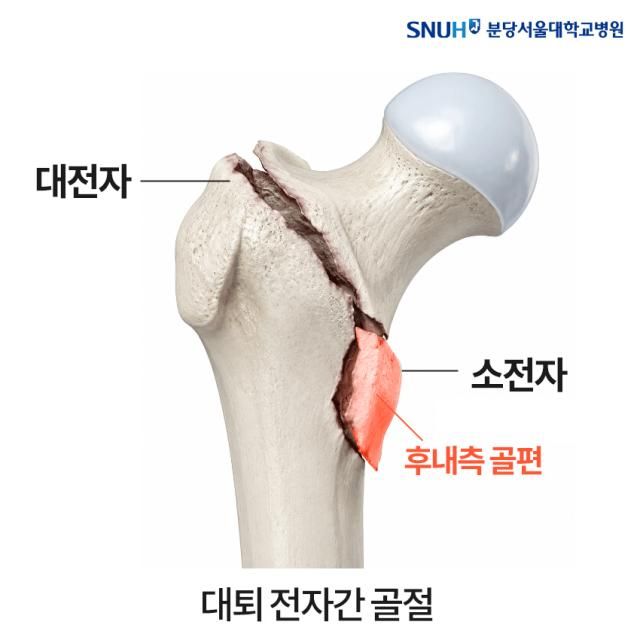 불안정성 대퇴 전자간 골절사진분당서울대병원