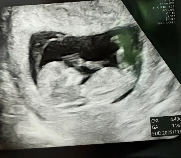 트루디가 올린 금똥이 태아 초음파 사진 사진트루디 SNS