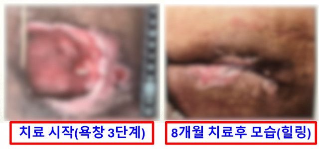 욕창-치료 전후 비교