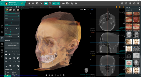 ‘Clever-One’ AI 기반의 3D 세그멘테이션 기능
