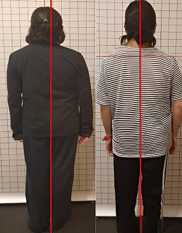 ▲ 측만증 개선사례(사진_라온필라테스 행신점)