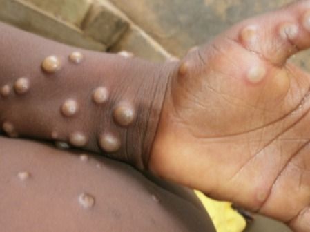 ▲ 원숭이 두창 환자의 피부 증상. 사진=나이지리아 질병통제센터 세계보건기구