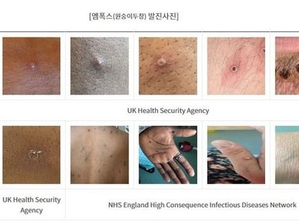 ▲ 엠폭스 감염자의 피부에 나타난 병변의 사진. 자료=울산시