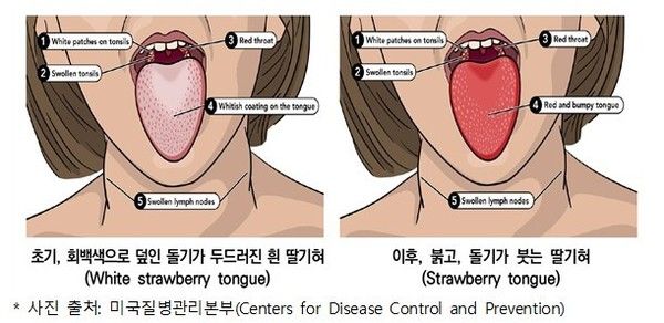 ▲ 성홍열 주요 증상. 사진=청주시