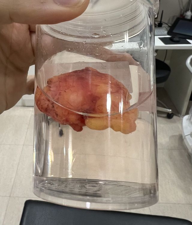 IMG_2478.jpeg [혐짤] 내 몸 안에서 나온 지방종 웃겨서 유머탭