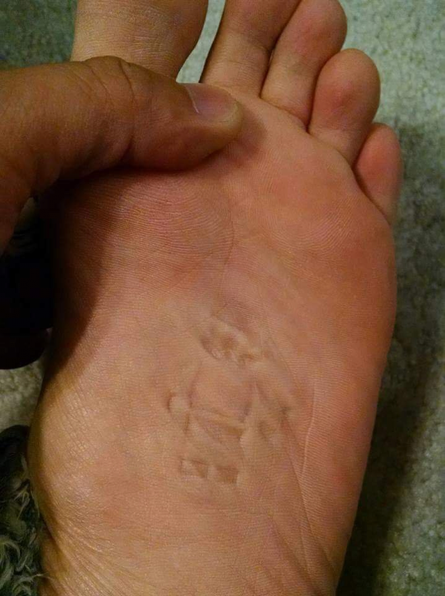 image.png 실수로 지뢰 밟은 발 상태 사진 ㄷㄷ