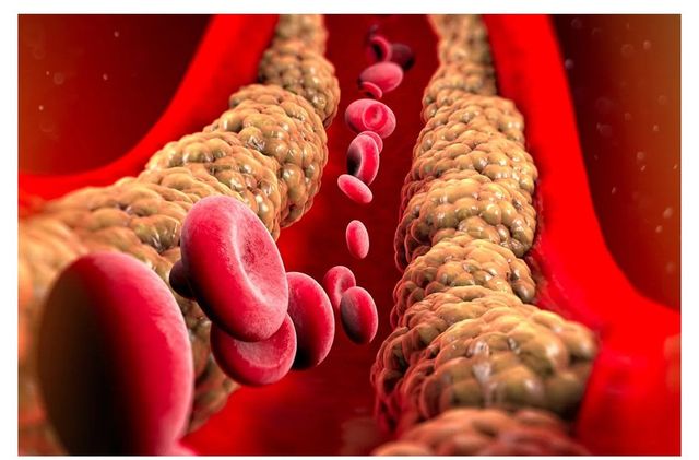 IMG_7544.jpeg 현재 개발중인 콜레스테롤 최대69%까지 줄이는 약물 근황